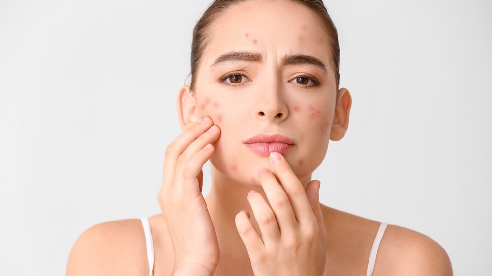 A woman caressing her face and having acne breakout