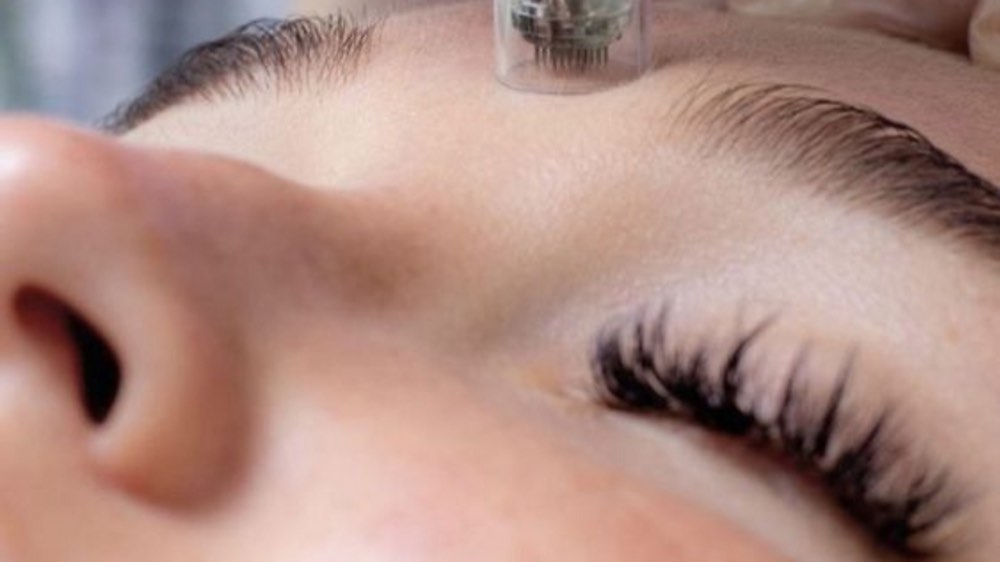 Top 5 Microneedling Benefits: How It Transforms Your Skin