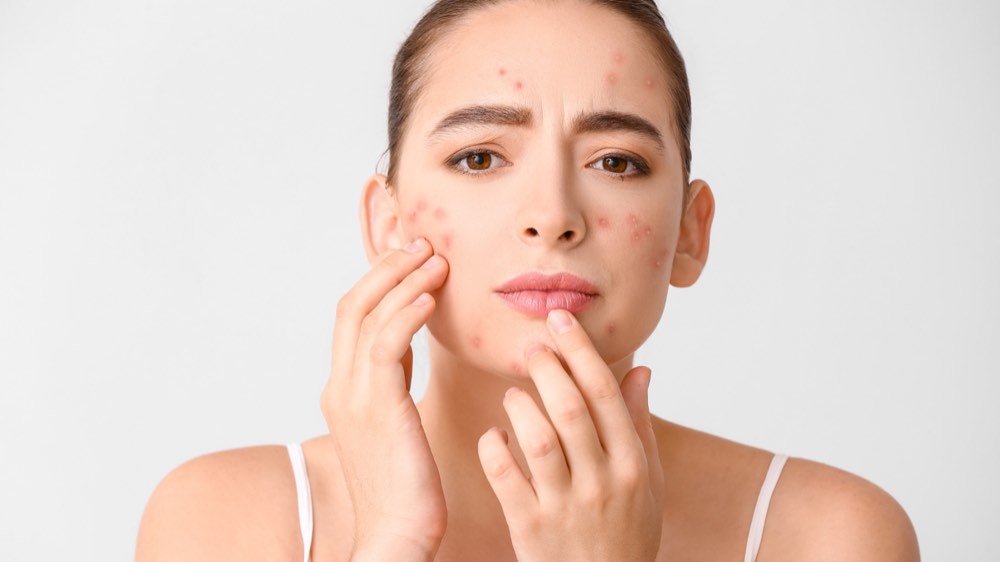 A woman caressing her face and having acne breakout